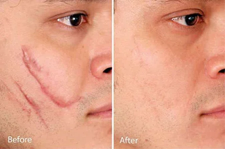 جدیدترین روشهای از بین بردن جای بخیه (از پماد تا لیزر)