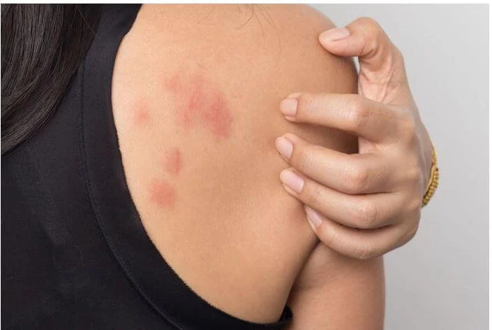 تست عفونت پوستی؛ راهی برای شناسایی علت عفونت